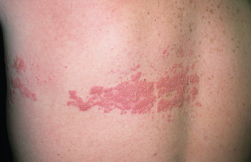 Shingles
